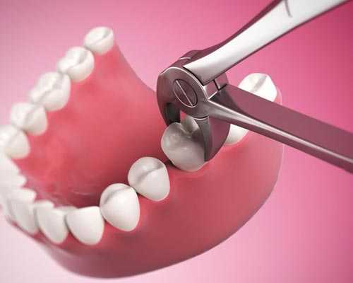 Theni Dental Extraction Specialist Chinnamanur