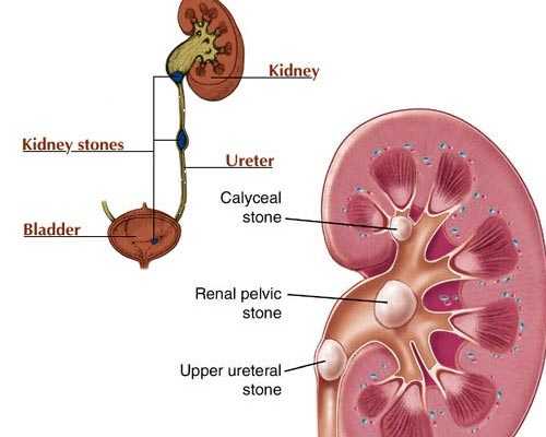 Ayurvedic kidney stones treatment Theni Cumbum