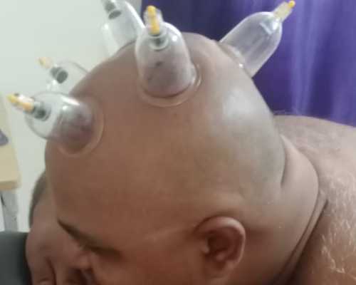 cupping therapy hair treatment Bodinayakanur