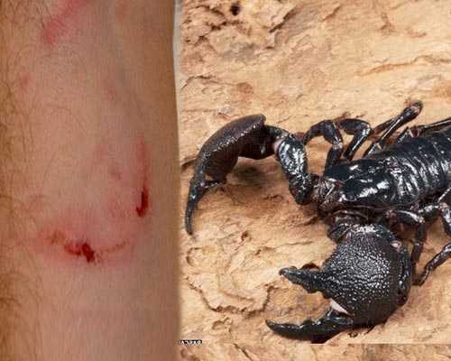 Madurai Scorpion Bite Ayurvedic Treatment Cumbum