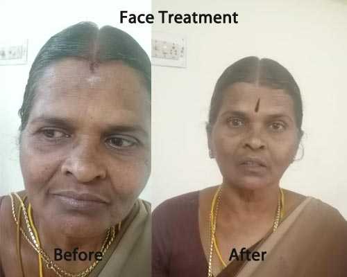 Acupuncture Face Stroke Treatment Batlagundu