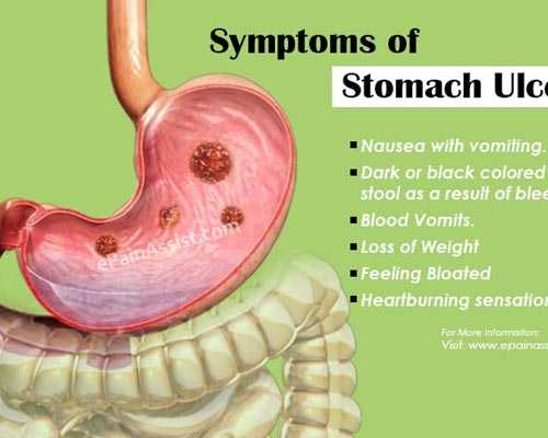 Stomach-Ulcer-Peptic-Ulcer-hospital-Tirumangalam-Cumbum