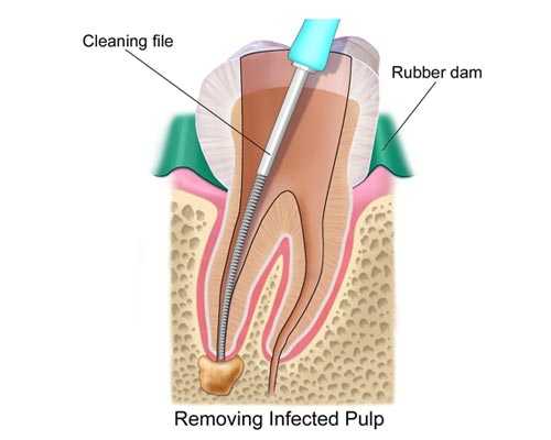 Root-Canal-Treatment-Expert-Cumbum-kumily